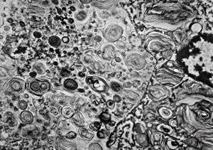 M, 6m. | Niemann-Pick disease - liver M, 6m. | Niemann-Pick disease - liver